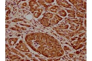 IHC image of ABIN7148861 diluted at 1:600 and staining in paraffin-embedded human pancreatic cancer performed on a Leica BondTM system. (CDK17 抗体  (AA 337-523))