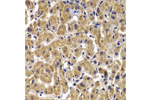 Immunohistochemistry of paraffin-embedded human liver cancer using MMP14 antibody. (MMP14 抗体)