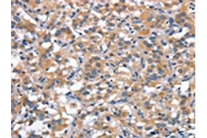 The image on the left is immunohistochemistry of paraffin-embedded Human thyroid cancer tissue using ABIN7189813(ANP32C Antibody) at dilution 1/30, on the right is treated with synthetic peptide. (ANP32C 抗体)