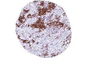 Testis HLA DRB1 negative seminoma showing HLA DRB1 staining of inflammatory cells and of small vessels HLA DRB1 immunohistochemistry