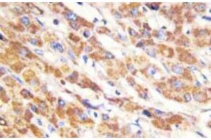 Immunohistochemistry (IHC) analyzes of Bax antibody in paraffin-embedded human liver carcinoma tissue. (LGALS7 抗体)