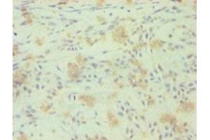 Immunohistochemistry of paraffin-embedded human breast cancer using ABIN7161881 at dilution of 1:100 (RORC 抗体  (AA 1-518))