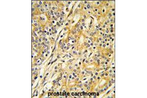 Formalin-fixed and paraffin-embedded human prostate carcinoma reacted with CYP51A1 Antibody , which was peroxidase-conjugated to the secondary antibody, followed by DAB staining.
