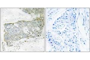 Immunohistochemistry analysis of paraffin-embedded human breast carcinoma tissue, using FA7 (light chain,Cleaved-Arg212) Antibody. (Factor VII 抗体  (Cleaved-Arg212))