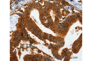 Immunohistochemistry of Human lung cancer using IL20RA Polyclonal Antibody at dilution of 1:35