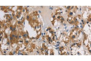 Immunohistochemistry of paraffin-embedded Human thyroid cancer tissue using DUSP26 Polyclonal Antibody at dilution 1:60 (DUSP26 抗体)