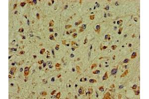 Immunohistochemistry of paraffin-embedded human glioma using ABIN7169039 at dilution of 1:100 (DCLK1 抗体  (AA 143-381))
