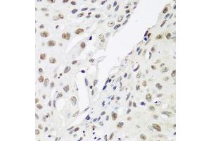 Immunohistochemistry of paraffin-embedded human lung cancer using CBX3 antibody at dilution of 1:200 (40x lens). (CBX3 抗体)
