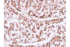 IHC-P Image Immunohistochemical analysis of paraffin-embedded human breast cancer, using ZNF323, antibody at 1:250 dilution. (Zinc Finger and SCAN Domain Containing 31 (ZSCAN31) (Center) 抗体)