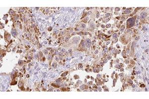 ABIN6273251 at 1/100 staining Human Melanoma tissue by IHC-P. (GREM2 抗体  (Internal Region))