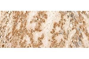 Immunohistochemistry of paraffin-embedded Human colorectal cancer tissue using HIST1H2BA Polyclonal Antibody at dilution of 1:45(x200) (HIST1H2BA 抗体)