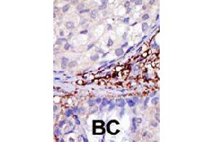 Formalin-fixed and paraffin-embedded human cancer tissue reacted with RNF216 polyclonal antibody  , which was peroxidase-conjugated to the secondary antibody, followed by DAB staining. (RNF216 抗体  (C-Term))