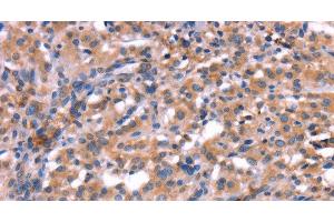 Immunohistochemistry of paraffin-embedded Human thyroid cancer using HMGCS1 Polyclonal Antibody at dilution of 1:40 (HMGCS1 抗体)