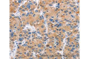 Immunohistochemistry of Human liver cancer using DKK2 Polyclonal Antibody at dilution of 1:60 (DKK2 抗体)