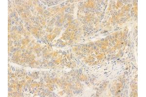 ABIN6260379 and ABIN6276678 at 1/100 staining human lung squamous cell carcinoma by IHC-P. (CA2 抗体  (C-Term))