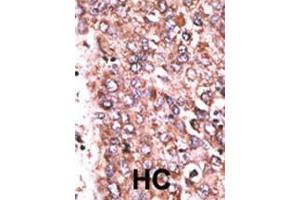 Formalin-fixed and paraffin-embedded human cancer tissue reacted with the primary antibody, which was peroxidase-conjugated to the secondary antibody, followed by DAB staining. (WISP3 抗体  (AA 305-335))