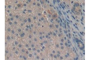 Detection of Slit2 in Human Liver cancer Tissue using Polyclonal Antibody to Slit Homolog 2 (Slit2) (SLIT2 抗体  (AA 1416-1528))