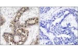Immunohistochemistry analysis of paraffin-embedded human breast carcinoma, using G3BP-1 (Phospho-Ser232) Antibody.