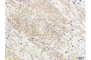 Formalin-fixed and paraffin-embedded: human breast cancer labeled with Rabbit Anti-HOXA10 Polyclonal Antibody (ABIN741195) , Unconjugated 1:200 followed by conjugation to the secondary antibody and DAB staining (HOXA10 抗体  (AA 311-410))