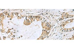 Immunohistochemistry of paraffin-embedded Human gastric cancer tissue using TUBD1 Polyclonal Antibody at dilution of 1:70(x200) (TUBD1 抗体)