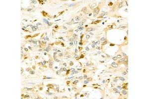 Immunohistochemistry of paraffin embedded human Cholangiocarcinoma using ANXA3 (ABIN7073065) at dilution of 1: 200 (400x lens) (Annexin A3 抗体)