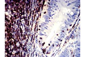 Immunohistochemical analysis of paraffin-embedded rectum cancer tissues using CD11a mouse mAb with DAB staining. (ITGAL 抗体  (AA 26-194))