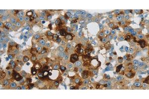 Immunohistochemistry of paraffin-embedded Human breast cancer using LCN2 Polyclonal Antibody at dilution of 1:60 (Lipocalin 2 抗体)