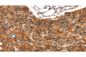 Immunohistochemistry of paraffin-embedded Human esophagus cancer tissue using TRIM69 Polyclonal Antibody at dilution 1:40 (TRIM69 抗体)