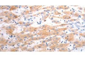 Immunohistochemistry of paraffin-embedded Human liver cancer using SLC22A6 Polyclonal Antibody at dilution of 1:40 (SLC22A6 抗体)