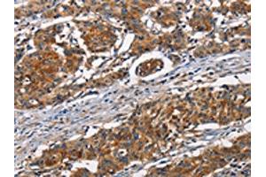 The image on the left is immunohistochemistry of paraffin-embedded Human gastic cancer tissue using ABIN7189936(ATP7A Antibody) at dilution 1/50, on the right is treated with synthetic peptide. (ATP7A 抗体)