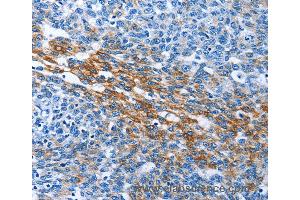 Immunohistochemistry of Human thyroid cancer using PAK6 Polyclonal Antibody at dilution of 1:40 (PAK6 抗体)