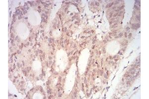 Immunohistochemical analysis of paraffin-embedded rectum cancer tissues using MAP2K3 mouse mAb with DAB staining. (MAP2K3 抗体  (AA 1-138))