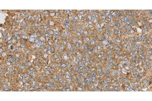 Immunohistochemistry of paraffin-embedded Human ovarian cancer using PTGER2 Polyclonal Antibody at dilution of 1:45 (PTGER2 抗体)
