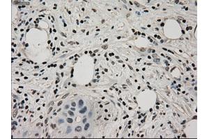 Immunohistochemical staining of paraffin-embedded Adenocarcinoma of ovary tissue using anti-LDHAmouse monoclonal antibody. (Lactate Dehydrogenase A 抗体)