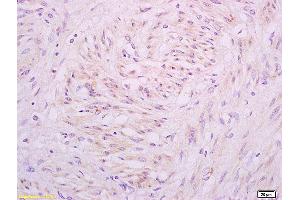 Formalin-fixed and paraffin embedded human cervical carcinoma tissue labeled with Anti A1BG Polyclonal Antibody,Unconjugated (ABIN872952) at 1:200 followed by conjugation to the secondary antibody and DAB staining. (A1BG 抗体  (AA 301-400))