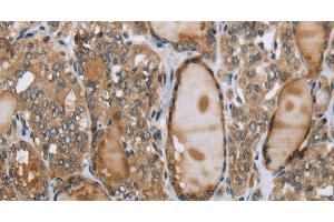 Immunohistochemistry of paraffin-embedded Human thyroid cancer using GGT1 Polyclonal Antibody at dilution of 1:40 (GGT1 抗体)