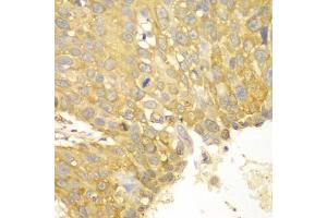 Immunohistochemistry of paraffin-embedded human lung cancer using ACTN1 antibody (ABIN5970506) at dilution of 1/100 (40x lens). (ACTN1 抗体)