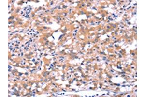 The image on the left is immunohistochemistry of paraffin-embedded Human thyroid cancer tissue using ABIN7190628(FAT1 Antibody) at dilution 1/40, on the right is treated with synthetic peptide. (FAT1 抗体)