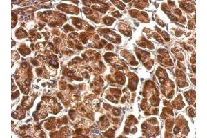 IHC-P Image Pyruvate Dehydrogenase E1 alpha antibody detects PDHA1 protein at cytosol on human hepatoma by immunohistochemical analysis. (Pyruvate Dehydrogenase E1 alpha (Center) 抗体)