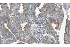 ABIN6274646 at 1/100 staining Human cervical cancer tissue by IHC-P. (CYP2C8 抗体)
