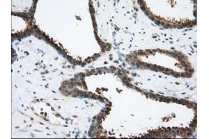 Immunohistochemical staining of paraffin-embedded Human prostate tissue using anti-ACAT2 mouse monoclonal antibody. (ACAT2 抗体)