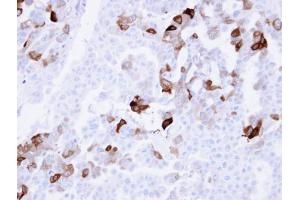 IHC-P Image Immunohistochemical analysis of paraffin-embedded OVCAR3 xenograft , using Carbonic anhydrase 2, antibody at 1:100 dilution. (CA2 抗体)