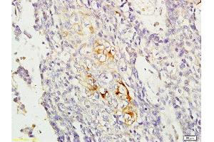Formalin-fixed and paraffin embedded human esophageal carcinoma labeled with Anti-RAB8 Polyclonal Antibody, Unconjugated  at 1:200, followed by conjugation to the secondary antibody and DAB staining (RAB8A 抗体  (AA 101-207))