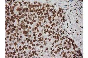 Immunohistochemical staining of paraffin-embedded Adenocarcinoma of Human breast tissue using anti-LOX mouse monoclonal antibody. (LOX 抗体  (AA 22-168))