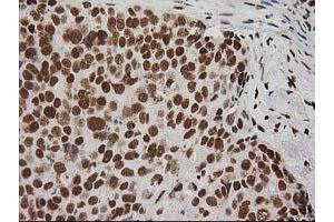 Immunohistochemical staining of paraffin-embedded Adenocarcinoma of Human breast tissue using anti-LOX mouse monoclonal antibody. (LOX 抗体  (AA 22-168))