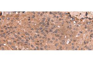 Immunohistochemistry of paraffin-embedded Human colorectal cancer tissue using IST1 Polyclonal Antibody at dilution of 1:40(x200) (IST1 抗体)