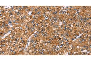 Immunohistochemistry of paraffin-embedded Human liver cancer using PAICS Polyclonal Antibody at dilution of 1:35 (PAICS 抗体)