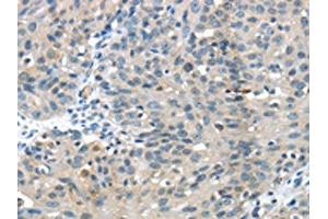 The image on the left is immunohistochemistry of paraffin-embedded Human breast cancer tissue using ABIN7129612(GLP2R Antibody) at dilution 1/30, on the right is treated with fusion protein. (GLP2R 抗体)