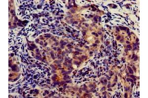 Immunohistochemistry of paraffin-embedded human pancreatic cancer using ABIN7144143 at dilution of 1:100 (SLC4A9 抗体  (AA 114-402))