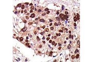 IHC analysis of FFPE human breast carcinoma tissue stained with the PKC nu antibody (PRKD3 抗体  (AA 352-384))